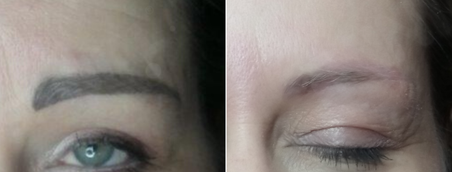 Detatouage Claye Souilly 77 et Cannes