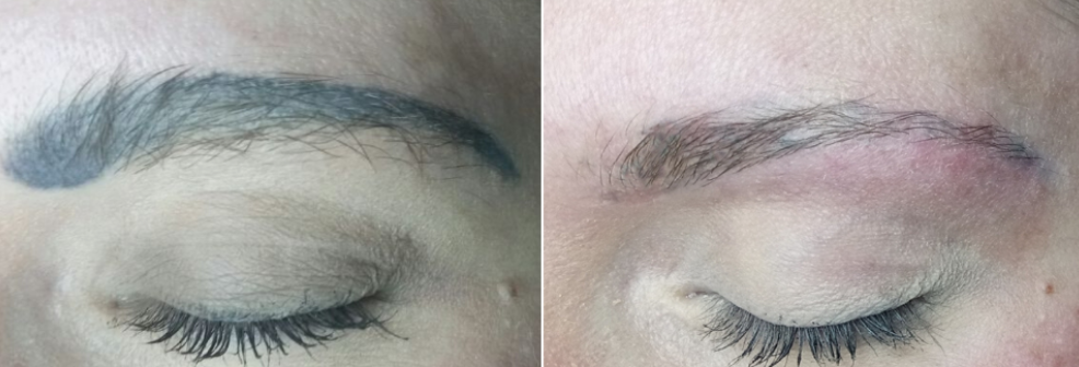 Detatouage Claye Souilly 77 et Cannes